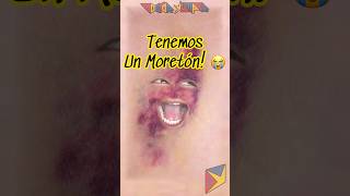 ¿Qué pasa con los hematomas 😨shortvideo [upl. by Jordana115]