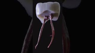 Every root canal is unique Cleaning and scaling teeth amp tartar amp calculus teethcare smileteethcare [upl. by Assira]