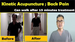 Acupuncture treatment for acute low back pain  Kinetic Acupuncture Back Pain Treatment [upl. by Omsoc]