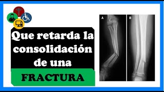 Fractura que NO CONSOLIDA ¿que puede ser  Que RETARDA tú CONSOLIDACIÓN [upl. by Prasad]