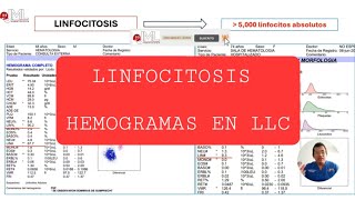 LINFOCITOSIS HEMOGRAMAS DE LEUCEMIA LINFOCÍTICA CRÓNICA [upl. by Prebo921]