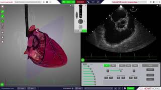 HeartWorks Right coronary artery regional wall motion abnormality [upl. by Isia242]