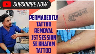 permanently tattoo removal by lasers and tattoo removal pen 🖊️ kay lasers tattoo removal hot hai [upl. by Alexei]