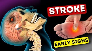 9 Warning Signs of Stroke One Month Before  Shocking Symptoms Revealed [upl. by Lyford]