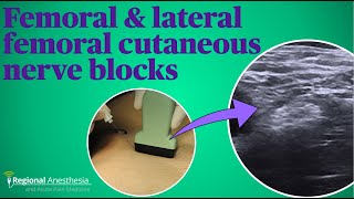 Femoral and lateral femoral cutaneous nerve blocks [upl. by Tollmann]