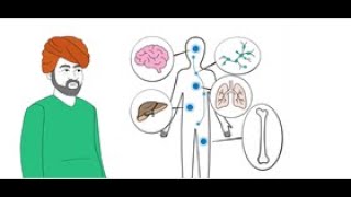 Cancer Basics – What is metastatic cancer [upl. by Varhol345]