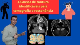 4 causas de tontura com achados na ressonância e tomografia [upl. by Aluap]