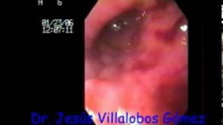 Duodenitis erosiva severa titulo Jesus Villalobosmpg [upl. by Campos74]