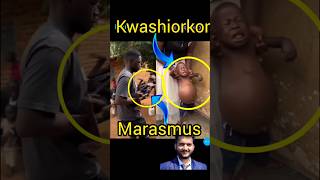 Kwashiorkor and marasmus shorts pna1 [upl. by Iline]