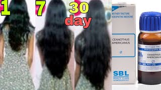 homeopathy treatment for hair loss Whats app 8981983618 [upl. by Herrle358]