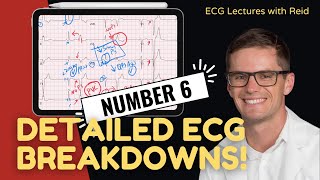 EKG Test Yourself  ECG Case Study 6 [upl. by Cutty357]