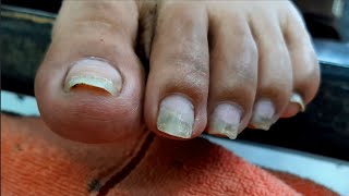 Satisfying Ingrown Toenail Removal  Dry Skin  Pedicure 143 [upl. by Ravaj]