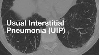 Usual Interstitial Pneumonia UIP [upl. by Nillad330]