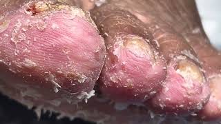 Complete process of pedicure nail fungus removal and feet shaving【Pedicure Master Lin Jun】 [upl. by Naut302]