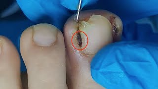 【Daily Pedicure Tutorial】Removing Deeply Embedded Ingrown Toenails on Both Sides of The Big Toe [upl. by Lusar]