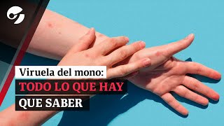 VIRUELA DEL MONO QUÉ ES Y CÓMO SE CONTAGIA  Todo lo que tenés que saber sobre Mpox [upl. by Leuneb499]