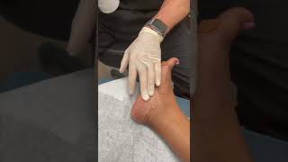 Cortisone Injection for Heel Pain Plantar Fasciitis [upl. by Lertram556]