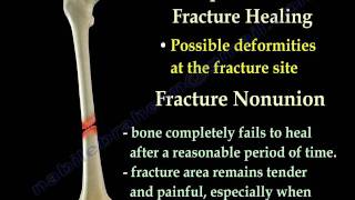 Fracture Healing Part 1  Everything You Need To Know  Dr Nabil Ebraheim [upl. by Fabri]