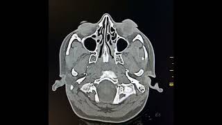 Otitis media and acute mastoiditis [upl. by Ffilc462]