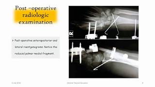 Distal Radius Articular Multifragmentary Fracture  El bilek eklem içi parçalı kırığı [upl. by Floro]