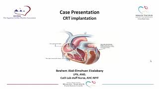 Cardiac resynchronization therapy CRT  Case study [upl. by Herod]