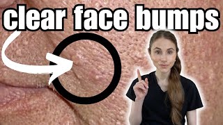 How To Clear And Prevent Face Bumps  Sebaceous Hyperplasia [upl. by Dnamra663]