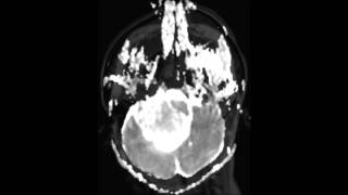 Choroid Plexus Papilloma [upl. by Lorac]