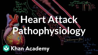 Heart attack myocardial infarction pathophysiology  NCLEXRN  Khan Academy [upl. by Ulberto]