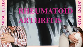 Curing Rheumatoid Arthritis Once and for All [upl. by Cinda]