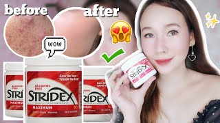 BEST amp EFFECTIVE SALICYCLIC ACID FOR ACNE PRONE SKIN STRIDEX TONER PADS REVIEW PHILIPPINES [upl. by Esinereb]