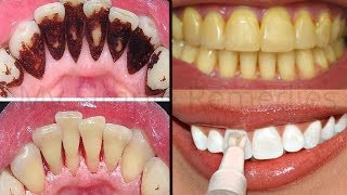 Just 1 Ingredient To Remove Dental Plaque amp Tooth Decay Whiten Your Teeth Instantly [upl. by Berard484]