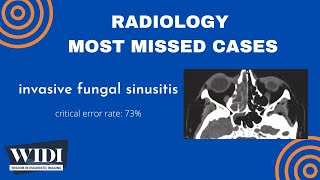 Most Missed Cases Invasive Fungal Sinusitis [upl. by Rochella]