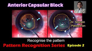 257 Anterior capsular block pattern recognition to avoid hydro rupture of PC Dr Sourabh Patwardhan [upl. by Anih]