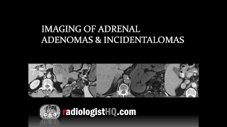 Imaging of Adrenal Adenomas amp Incidentalomas [upl. by Ppilihp]