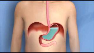 Heartburn Acid Reflux GERDMayo Clinic [upl. by Nyleak]