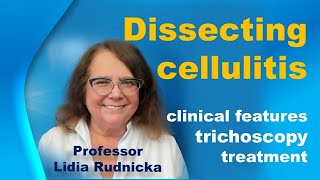 Dissecting cellulitis  clinical features trichoscopy treatment [upl. by Thamora]