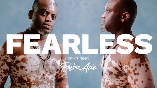 I Hid My Vitiligo But Now I Embrace It  BASHIR AZIZ  FEARLESS EPISODE 4 [upl. by Tlevesoor]