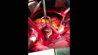 Dr Satyajit Bose Mitral Valve Repair [upl. by Autum]