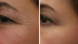 How to Remove Under Eye Wrinkles Fast and Naturally [upl. by Asilec]