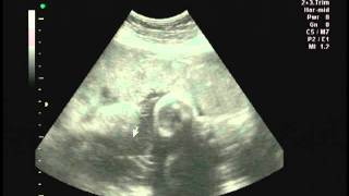 Ultrasound scan at 35 week pregnancy [upl. by Rufena]