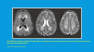 Neurology Quiz 103 Metachromatic leukodystrophy MLD [upl. by Charron835]