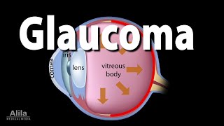 Development of Glaucoma Animation Open Angle vs Angle Closure Glaucoma [upl. by Ojyllek]