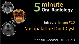 Nasopalatine duct cyst Intraoral Radiographic Interpretation [upl. by Anitnauq]