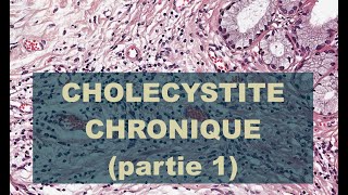 CHOLECYSTITE CHRONIQUE partie 1  PATHOLOGIE [upl. by Etennaej940]