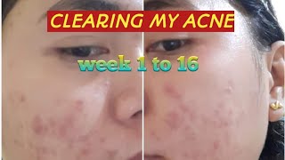 PURGING AND WEEKLY PROGRESS USING EPIDUO  Acne Cure  Philippines [upl. by Ball]