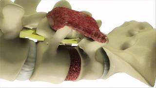 Transforaminal Lumbar Interbody Fusion TLIF  DePuy Videos [upl. by Verlee]