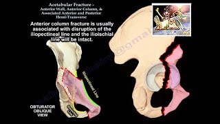 Acetabulum Anterior Wall Column HemiTransverse  Everything You Need To Know  Dr Nabil Ebraheim [upl. by Ailhad]