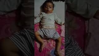 Infantile spasmWest syndrome Dr Asim Shrestha [upl. by Dibbell]