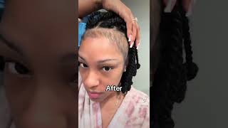 I grew my edges back using Minoxidil 5 minoxidil hairloss beforeandafter hairgrowth alopecia [upl. by Robbin177]