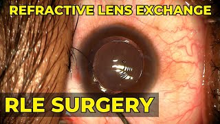 What Is RLE Surgery I Live RLE Surgery Procedure [upl. by Langley659]